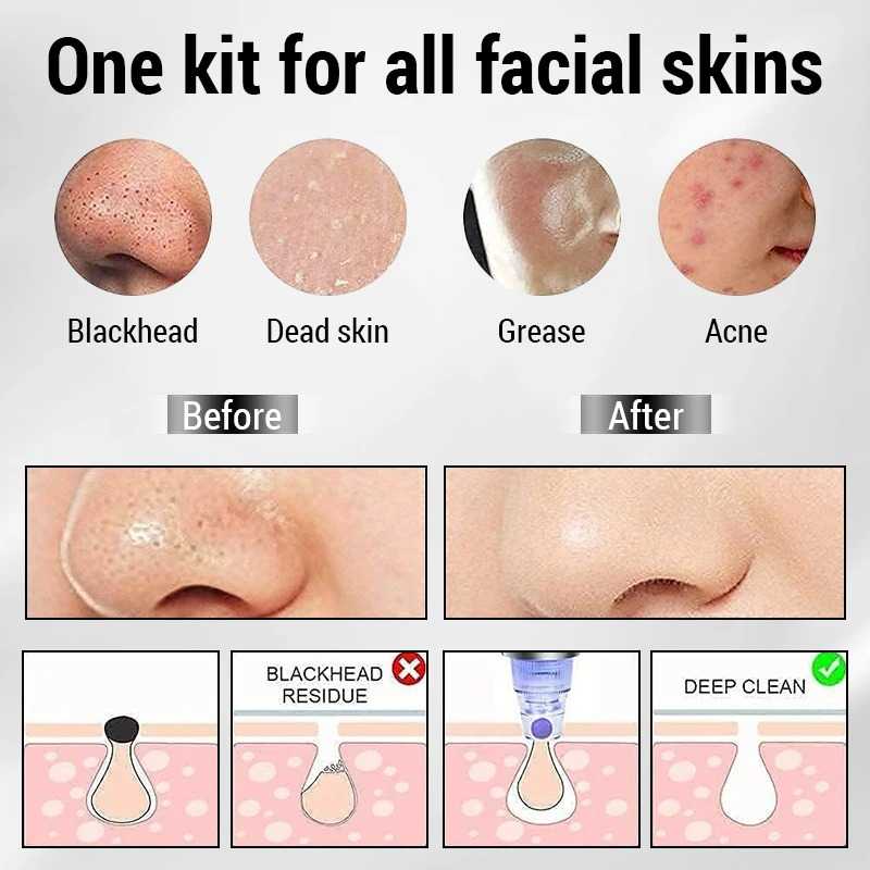 Electric Blackhead Remover — Pore Vacuum for Deep Face Cleansing and Clearer Skin